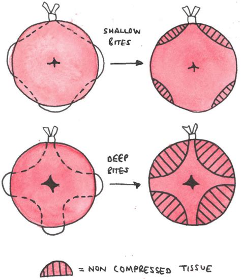 History Of Cervical Cerclage Placement - Infoupdate.org