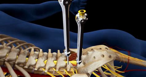 L5-S1 Herniated Disc Surgery - DiscSeel - Non-Surgical Spine Procedure