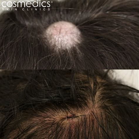 Cyst Removal London Surgical Treatment | Cosmedics Skin Clinics