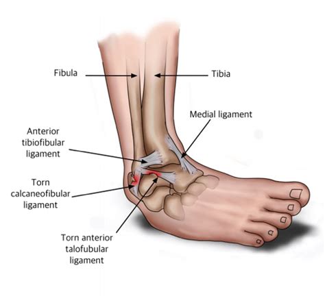 Ligaments torn in a Lateral Ankle Sprain - Ryde Natural Health Clinic