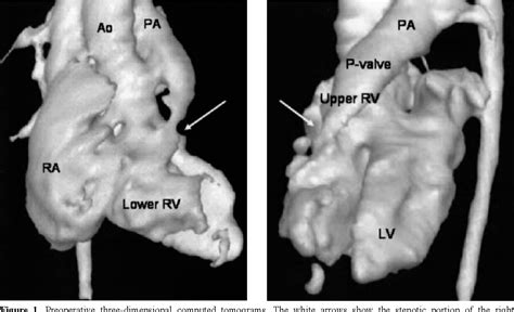 Figure 1 from Double-Chambered Right Ventricle in Adulthood | Semantic ...