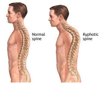 Hyper-Kyphosis - Scoliosis Clinic UK - Treating Scoliosis without surgery