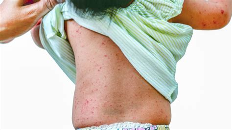 Roseola Rash (Sixth Disease) in Children and Adults – The Amino Company