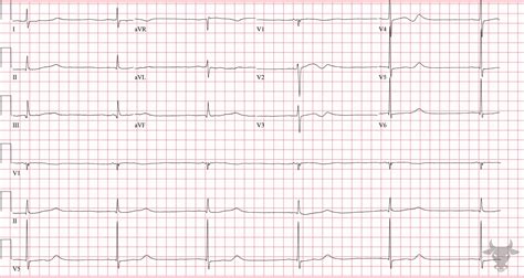 Sinus Node Dysfunction | ECG Stampede