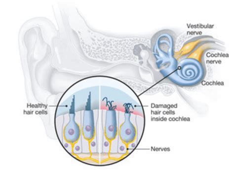 Signs That Tinnitus is Going Away