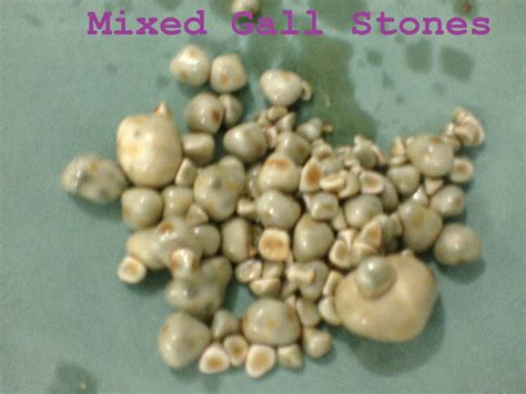 Introduction of Gallbladder Stones (Cholelithiasis) « General Surgical ...