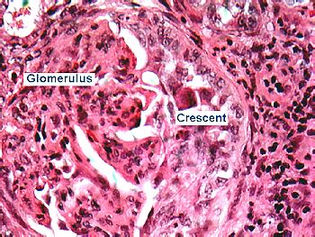 crescents in RPGN (can be caused by Goodpasture, Wegener's and Microscopic Polyangitis ...