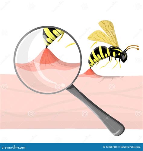 Wasp Sting Human. Close Up Detailed With Magnifier Pathogenesis Of Bee Stings And Allergic ...