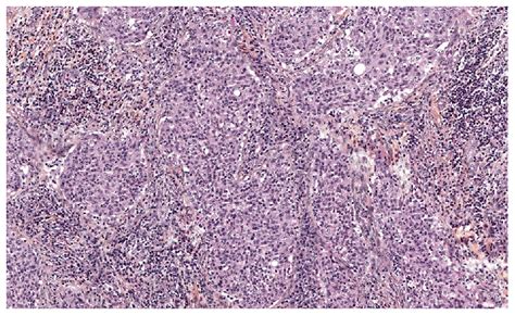 Initial diagnosis pathology specimen of the first patient.... | Download Scientific Diagram