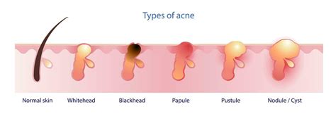 Types of acne vector isolated on white background. Formation of normal skin, acne, pimple ...