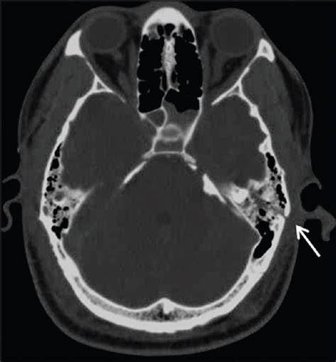 Basal Skull Fracture