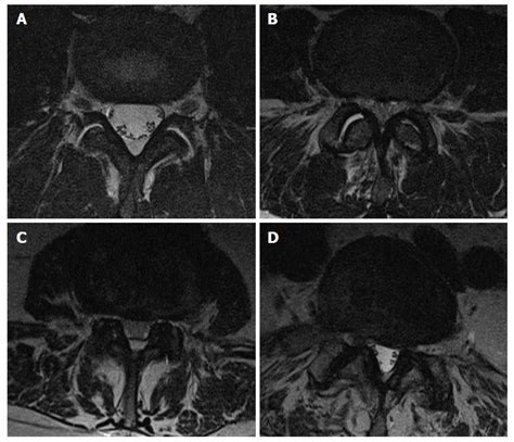 Lateral Recess Lumbar