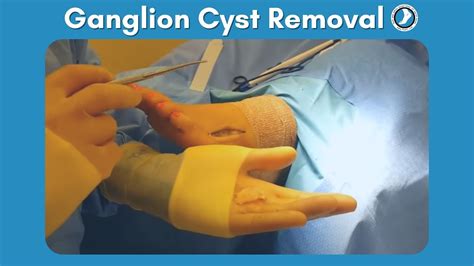Ganglion Cyst Wrist Pictures Treatment Surgery Causes - vrogue.co