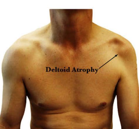 Anatomia - Axillary nerve injury 😷