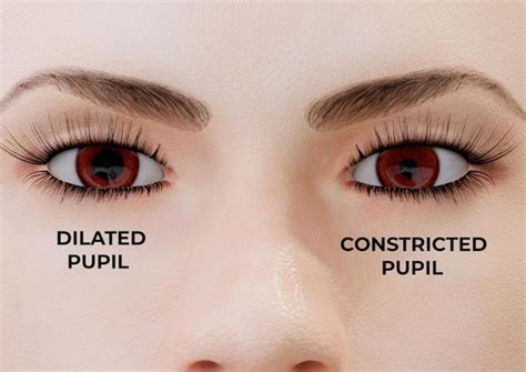 Premium Photo | Miosis is a condition in which one or both pupils constrict, regardless of how ...