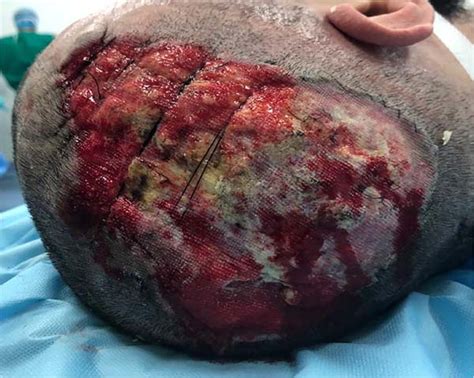 RBCP - Cutis verticis gyrata resection with scalp reconstruction: a case report