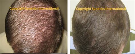 Award Winning Laser Hair Restoration Without Surgery or Drugs - Skin ...