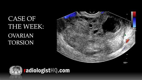 Case of the Week: Ovarian Torsion (Ultrasound) - YouTube