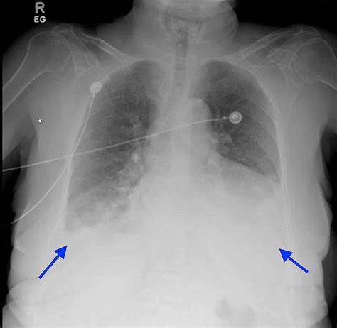 A Case of Seronegative ANA Hydralazine-Induced Lupus Presenting With ...