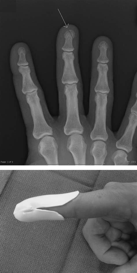 Pediatric Hand Injuries | Pediatric Emergency Playbook