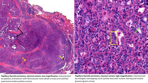 Variants of Papillary Thyroid Carcinoma (Microcarcinoma, Tall Cell, Columnar, Follicular) | Iowa ...