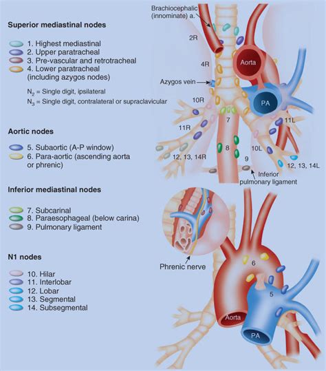 Hilar Lymph Nodes Lung Cancer