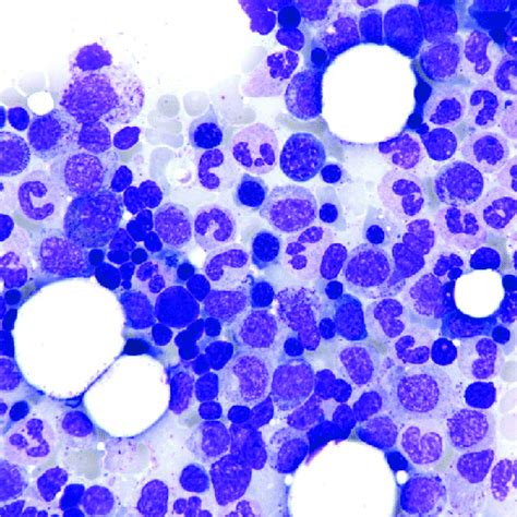 Bone marrow aspirate with normal erythropoiesis (Wright-Giemsa ...