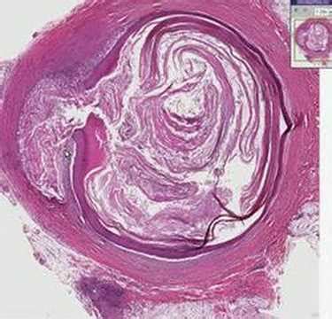 Histopathology Skin--Epidermal inclusion cyst - YouTube