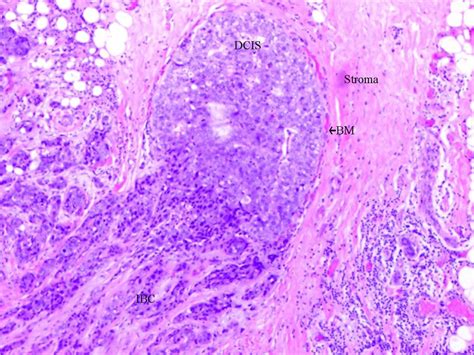 Ductal Carcinoma In Situ Histology