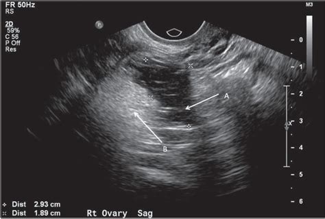 Ultrasound of ovarian dermoids – sonographic findings of a dermoid cyst in a 41‐year‐old woman ...