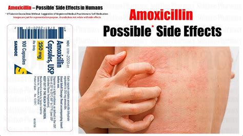 Amoxicillin = Possible * Side Effect of Amoxicillin | Amoxicillin Antibiotic Overdose Side ...