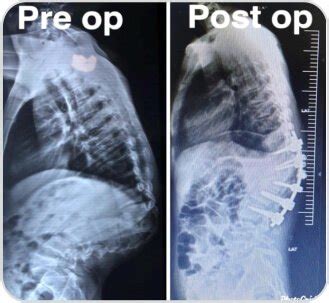 Role of Corpectomy in Spine Surgery at Yashoda Hospitals