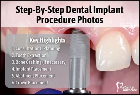 Step-By-Step Dental Implant Procedure Photos | MDA