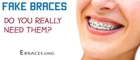 Do You Really Need Fake Braces?