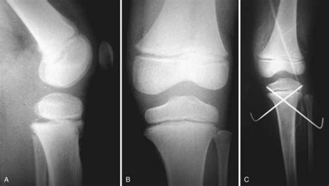 Physeal Fractures About the Knee | Musculoskeletal Key