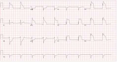 Angina Pectoris, Variant; Prinzmetal Angina