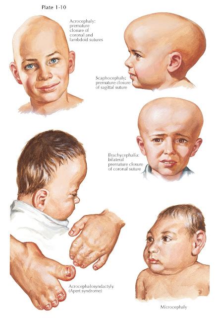 CRANIOSYNOSTOSIS - pediagenosis