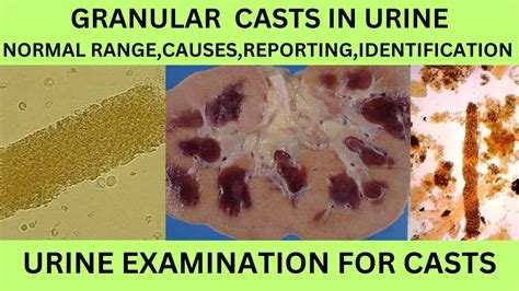 GRANULAR CASTS IN URINE.CAUSES SYMPTOMS TREATMENT OF GRANULAR CASTS IN URINE EXAMINATION IN ...