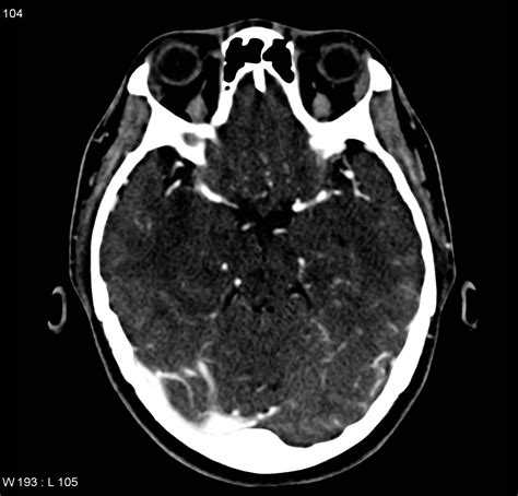 Cerebral venous sinus thrombosis CT - wikidoc