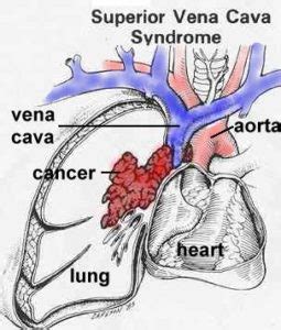 svc_anatomy - RCEMLearning