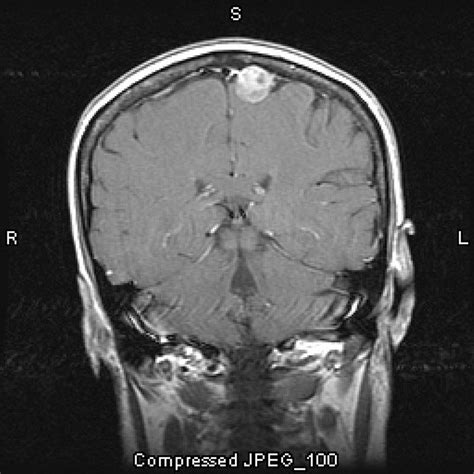 Image: Meningioma, Parasagittal - MSD Manual Professional Edition