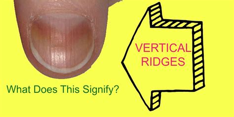 Symptoms Of Hyperparathyroidism | Vertical nail ridges, Fingernails