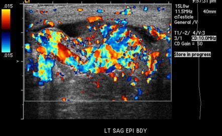 Epididymitis | Radiology Reference Article | Radiopaedia.org