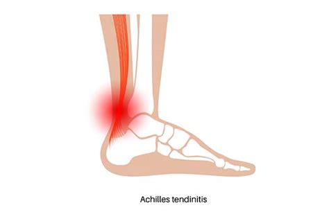 Achilles Tendonitis Treatment | Specialist Orthopaedic Centre