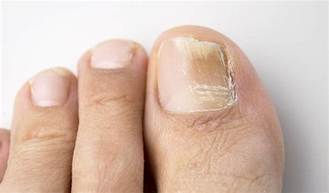 FUNGAL NAILS - Onychomycosis | Nail Infections, Causes & Treatments | FootSmart Podiatry