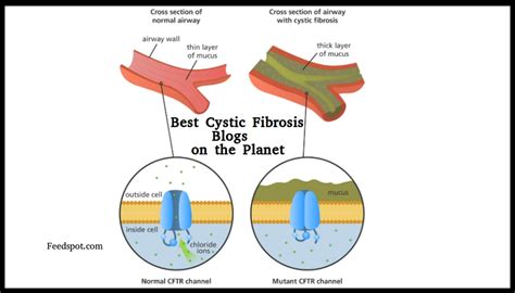 Top 40 Cystic Fibrosis Blogs and Websites in 2021