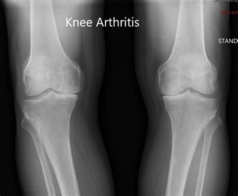 Case Study: Bilateral Knee Replacement in 72 Year Old Female