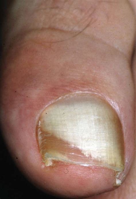 Onychomycosis causes, clinical appearance and onychomycosis treatment