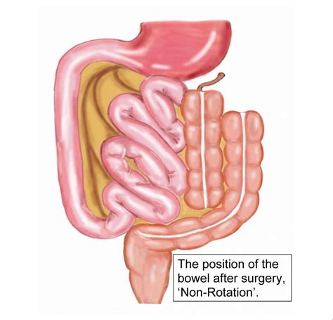 Intestinal malrotation - Royal Manchester Children's Hospital