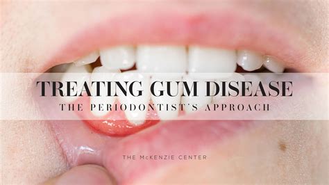 Treating Gum Disease — The McKenzie Center | Implants & Periodontics